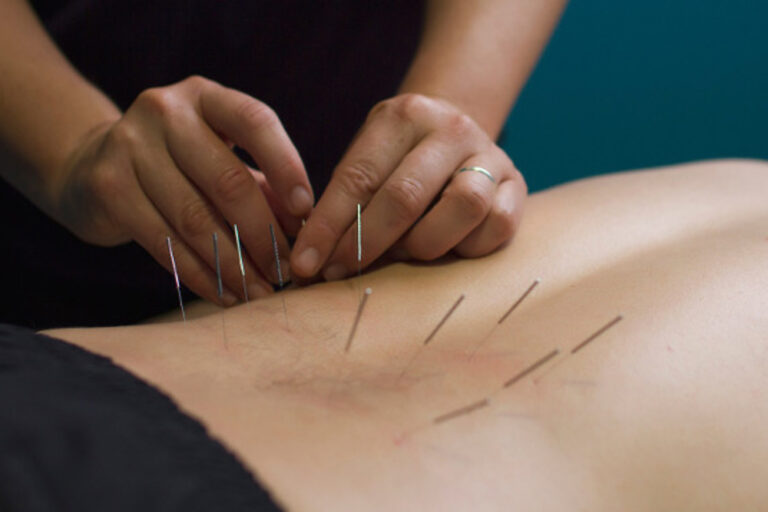 Dry needling therapist in Pune